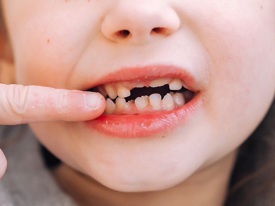 Tips to Prevent Cavities