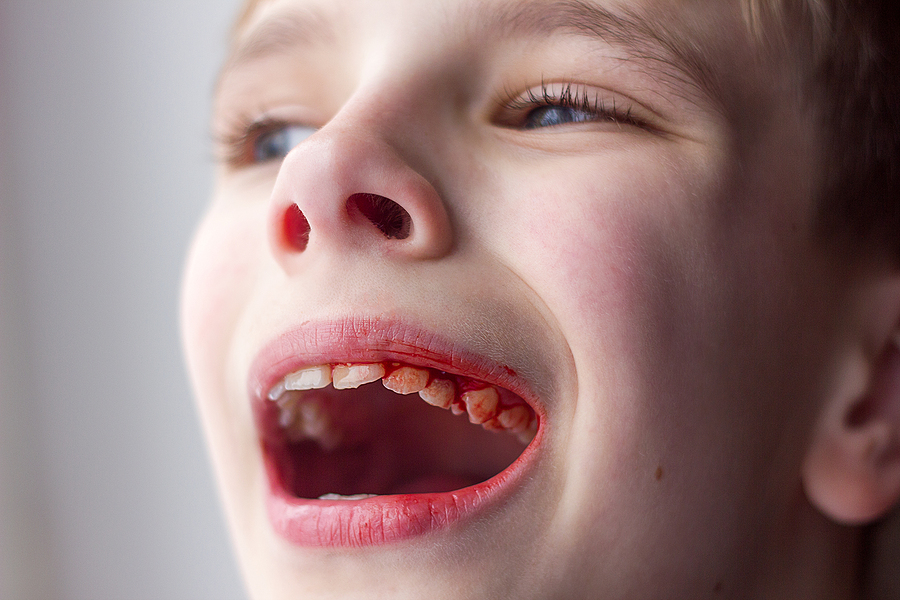 Traumatic Dental Injuries